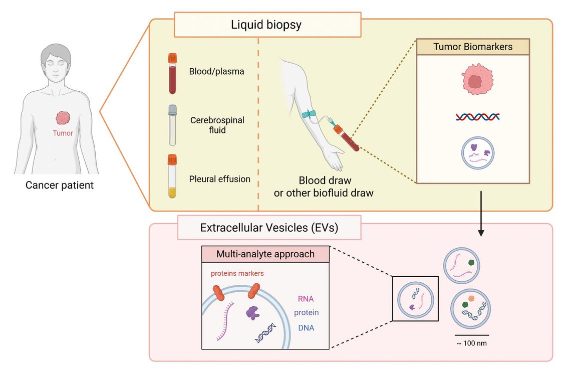 EV Diagnostics: Extracellular Vesicles as Diagnostic Biomarkers in ...