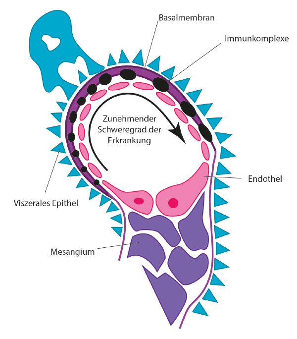 Autoimmunerkrankungen Fast Immer Auf Die Niere Trillium Gmbh Medizinischer Fachverlag