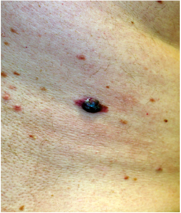 Brapidly accelerated (BRAF)