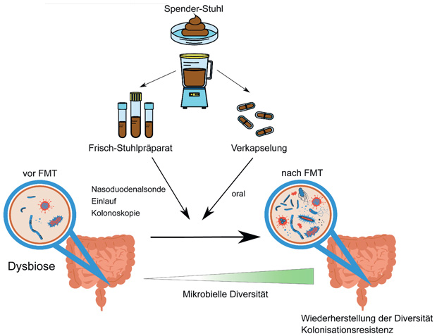 FMT: fekäle Mikrobiota Transfer